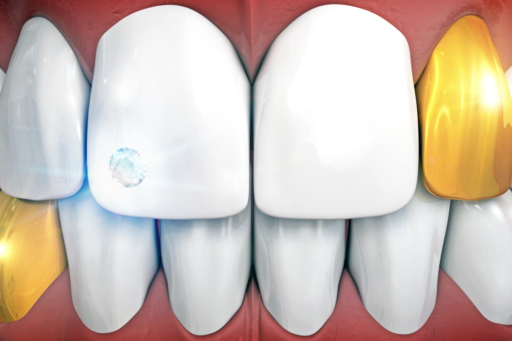 Ästhetische Zahnmedizin, Zahnschmuck, Zahnarztpraxis Zahn und Biss, Dr. med. dent. Emilia Velea, 3063 Ittigen