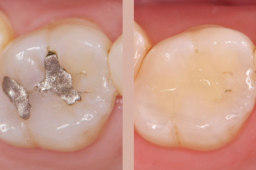 Zahnsanierungen , Zahnarztpraxis Zahn und Biss, Dr. med. dent. Emilia Velea, 3063 Ittigen